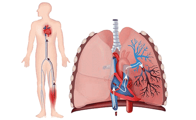 Первичная лёгочная гипертензия