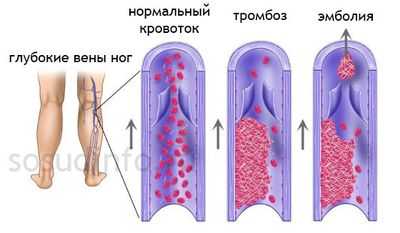 Легочное сердце