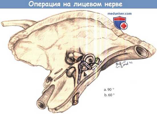 Операция на лицевом нерве