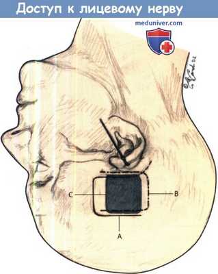 Доступ к лицевому нерву