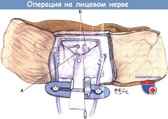 Операция на лицевом нерве