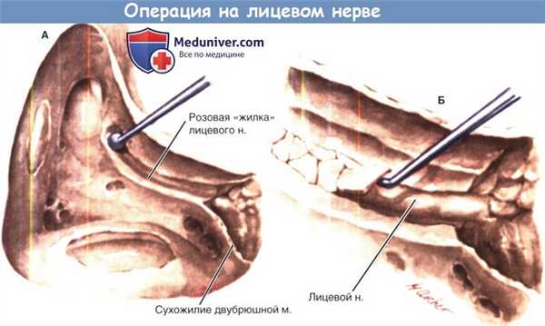 Операция на лицевом нерве