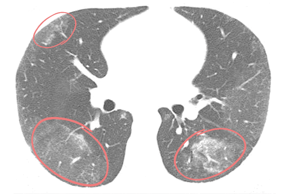 Опухоли бронхов