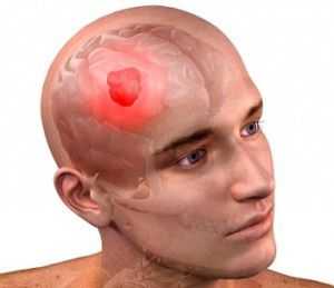 Опухоль головного мозга