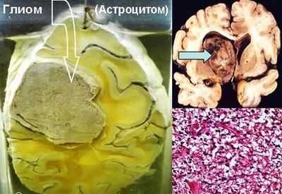Астроцитома и глиома
