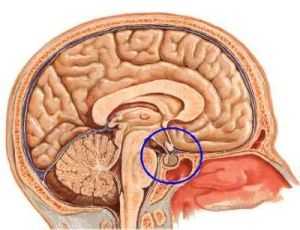 Опухоль в мозгу