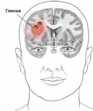 Локализации глиомы