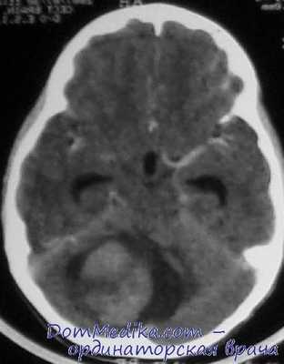 опухоли мозжечка у детей