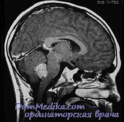 опухоли мозжечка у детей