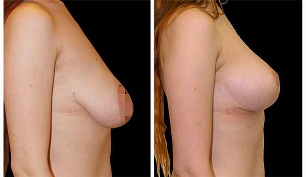 Фото подтяжки груди ДО и ПОСЛЕ