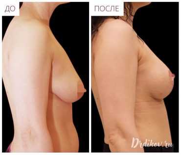 Уменьшение груди