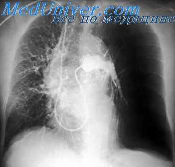 осложнения ангиографии