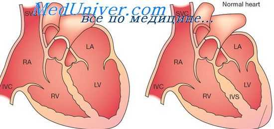 сердце при алкоголизме