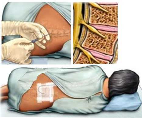 Эпидуральная анестезия - безболезненный и безопасный метод обезболивания при операциях