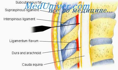 эпидуральная блокада