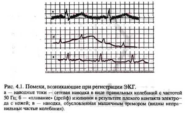 Какие проблемы могут возникнуть при регистрации ЭКГ