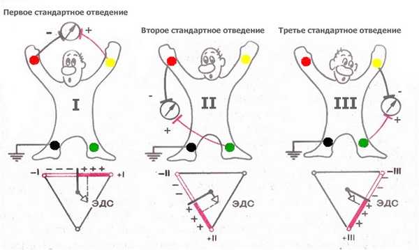 Правильная фиксация электродов