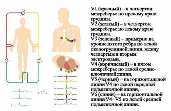 Правильная фиксация электродов 1