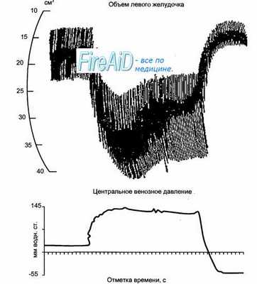 Сердечный выброс. Регуляция сердечного цикла. Миогенные механизмы регуляции деятельности сердца. Эффект Франка — Старлинга.