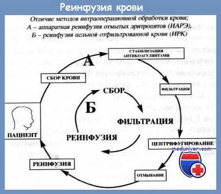 реинфузия крови
