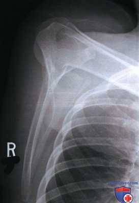 Укладка при рентгенограмме лопатки в боковой проекции (латеромедиальной, медиолатеральной)