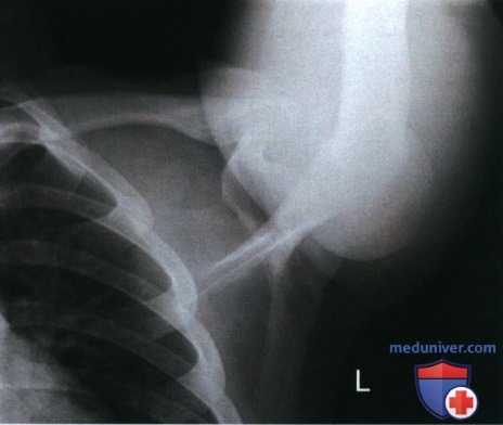 Рекомендации по анализу рентгенограммы плечевого сустава в аксиальной ПЗ проекции (метод Страйкера)