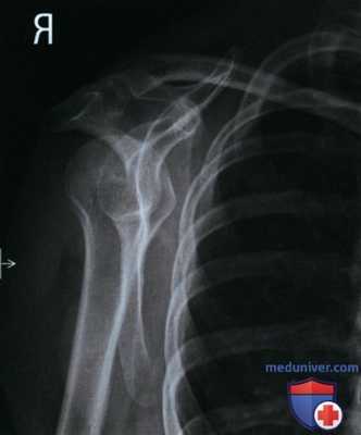 Укладка при рентгенограмме плечевого сустава в косой ЗП проекции (лопаточной Y проекции)