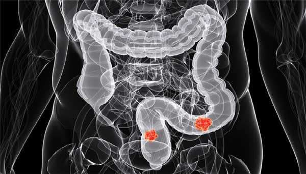 Рентген кишечника