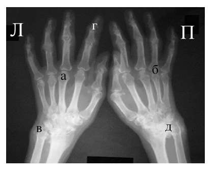 Рис. 4. Изменения кистей при ревматоидном артрите (а остеопороз, бсужение суставных щелей, в кистовидные просветвления, г костные эрозии, д анкилозирование)