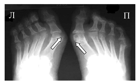 Рис. 2 Симптом «пробойника» в головках плюсневых костей обеих стоп в сочетании с вальгусной девиацией I плюсне-фаланговых суставов