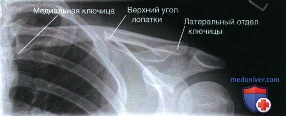 Укладка при рентгенограмме ключицы в передне-задней проекции (ПЗ проекции)