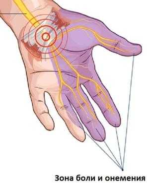 Зона боли и онемения при туннельном синдроме