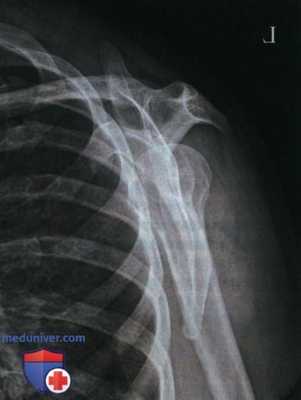 Укладка при рентгенограмме плечевого сустава в косой ЗП проекции (лопаточной Y проекции)