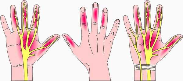 Чувствительные нарушения в пальцах при синдроме запястного канала