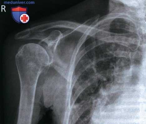 Укладка при рентгенограмме плечевого сустава в передне-задней проекции (ПЗ проекции)