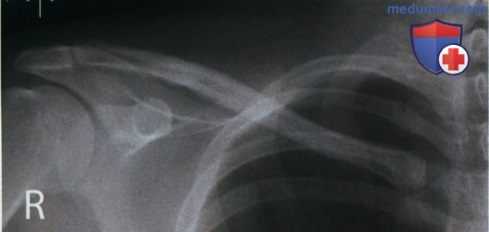Укладка при рентгенограмме ключицы в передне-задней проекции (ПЗ проекции)