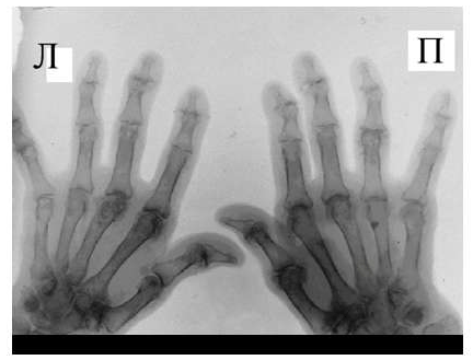 Рис. 6 Сужение суставной щели, остеофиты и субхондральный остеосклероз, кистовидные просветления костной ткани, костные дефекты (псевдоэрозии), деформации эпифизов костей при остеоартрозе.