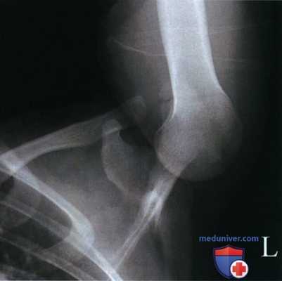 Рекомендации по анализу рентгенограммы плечевого сустава в аксиальной ПЗ проекции (метод Страйкера)