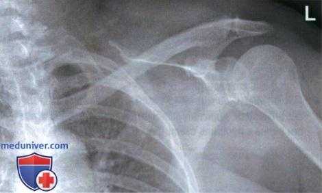 Укладка при рентгенограмме плечевого сустава в передне-задней проекции (ПЗ проекции)