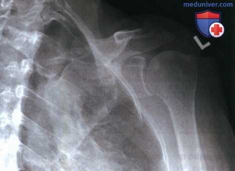 Укладка при рентгенограмме плечевого сустава в передне-задней проекции (ПЗ проекции)
