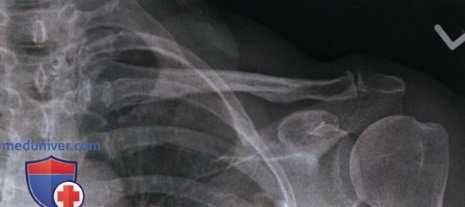 Укладка при рентгенограмме ключицы в аксиальной ПЗ проекции