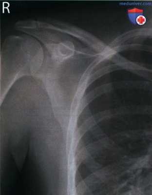 Укладка при рентгенограмме лопатки в ПЗ проекции