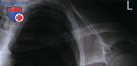 Укладка при рентгенограмме ключицы в передне-задней проекции (ПЗ проекции)