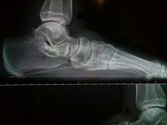 Боковая проекция стопы с нагрузкой