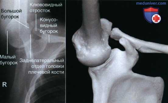 Рекомендации по анализу рентгенограммы плечевого сустава в аксиальной ПЗ проекции (метод Страйкера)