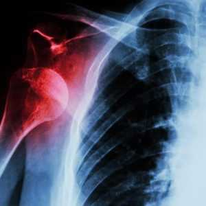 Рентген (рентгенография) плечевой кости