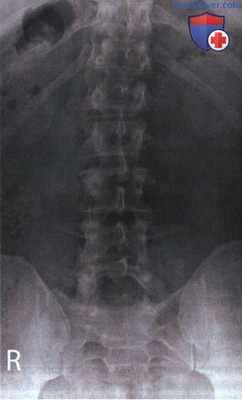 Рентгенограмма поясничных позвонков в ПЗ проекции
