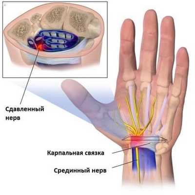 Туннельный синдром