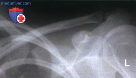 Укладка при рентгенограмме ключицы в передне-задней проекции (ПЗ проекции)