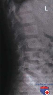 Рентгенограмма поясничных позвонков в боковой проекции